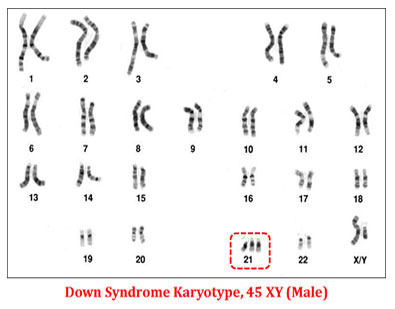 karyotype of down syndrome female