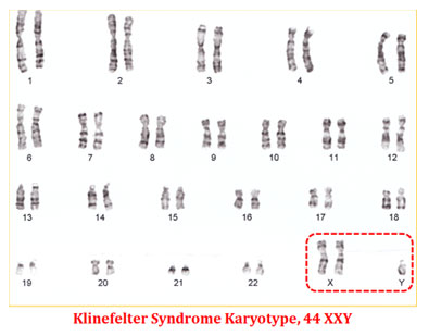 karyotype of Klinefelter's syndrome