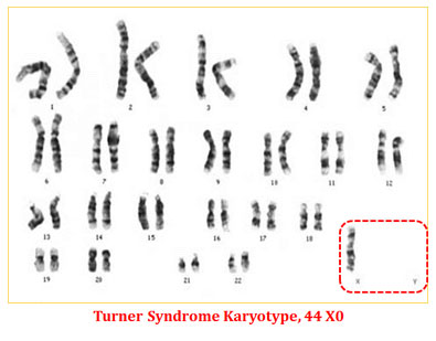 karyotype of turner syndrome